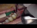 Khoury bone graft technique and sinus lift