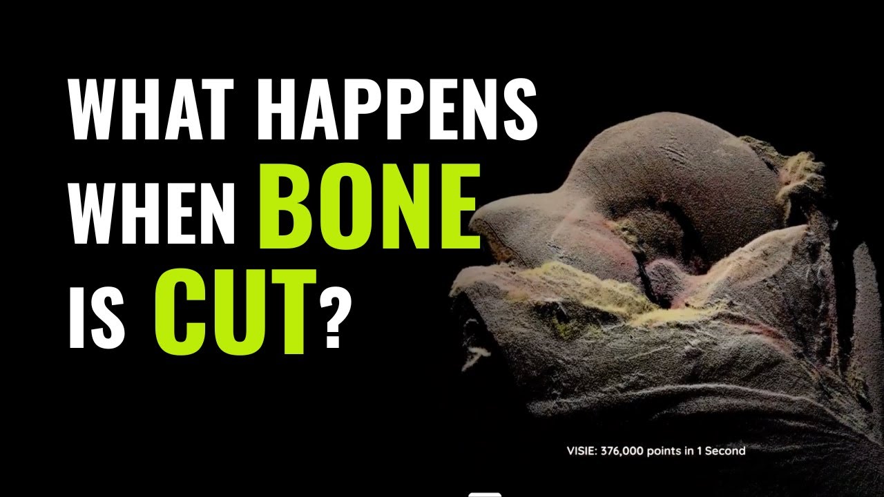 How VISIE Keeps 3D Models Accurate During Surgery