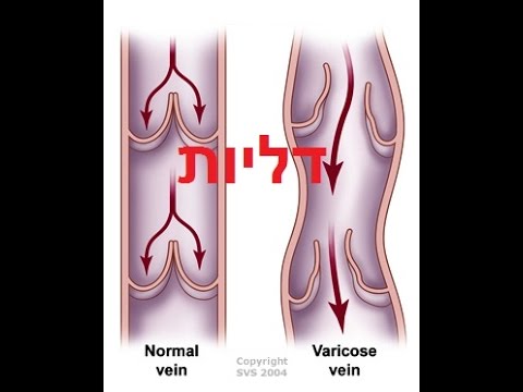 דליות ורידים מורחבים טיפול טבעי, דליות שוקיים, דליות ברגליים, ורידים מורחבים