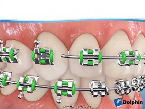 Notfall Tipps Bei Spangen Zahnspangen Brackets Wehr Aarau Dr