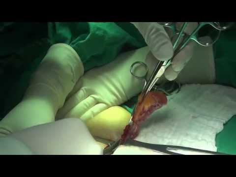 APPENDECTOMY Double Ligation