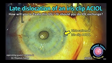 CataractCoach™ 2251: late ontwrichting van een irisclip ACIOL
