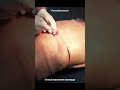 Пункція порожнини перикарду на симуляційному манекені TraumaMan Simulab.Pericardial puncture.