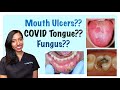 COVID-19 Oral Symptoms Explained | COVID-Tongue