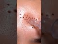 Vacuum vs Extractor | Blackhead Lab Experiment