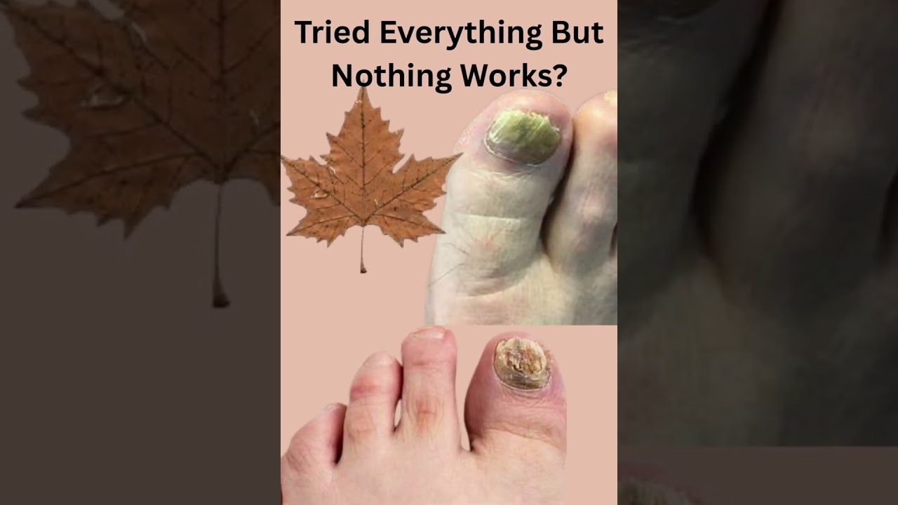 Toenail Fungus Gone Naturally? Here’s How