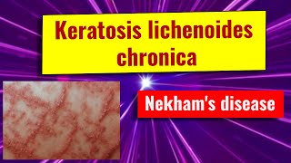 Keratosis Lichenoides Chronica Overview, Causes, Features, Management
