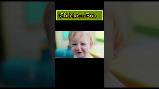 Chickenpox, Causes, Symptoms & Treatment|VARICELLA ZOSTER VIRUS |Shingles Rash #shingles #chickenpox