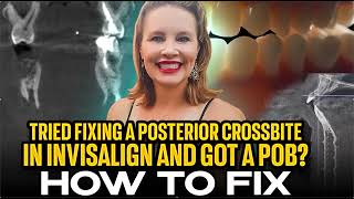 Crossbites and POB's- How to Fix in Aligners / Invisalign