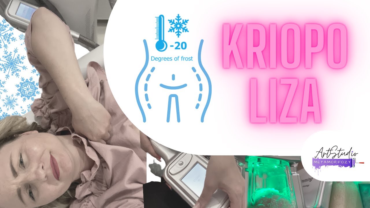 KRIOPOLIZA - jak szybko zgubić brzuch bez sportu ❓🎥