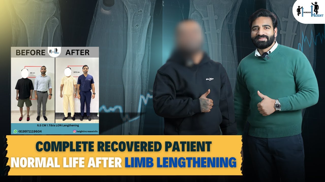 Полное выздоровление пациента, нормальная жизнь после удлинения конечностей | Операция по увеличе...