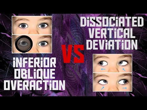 SPOT THE DIFFERENCE - Dissociated vertical deviation vs Inferior oblique overaction