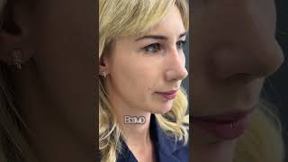 10 месяцев после ринопластики  ☎️ +7(985)002-10-50