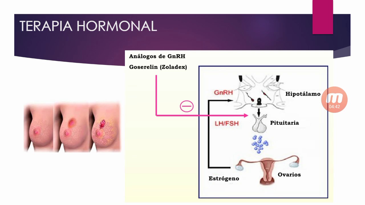 cancere hormonale