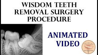 Procedures for Wisdom Tooth Removal Surgery - Third molar Extraction