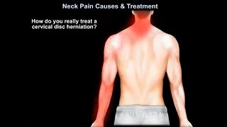 Neck Pain Causes,  symptoms, diagnosis  and Treatment