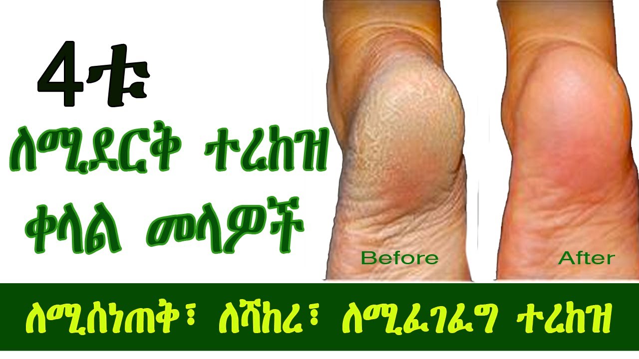 4ቱ ለሚሰነጠቅ፣ ለሻከረ፣ ለሚፈገፈግ፣  ለሚደርቅ ተረከዝ ቀላል መላዎች 4 Easy Cracked Heel Home Remedies