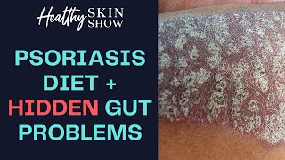 Psoriasis Diet + HIDDEN Gut Problems | Emma Gould