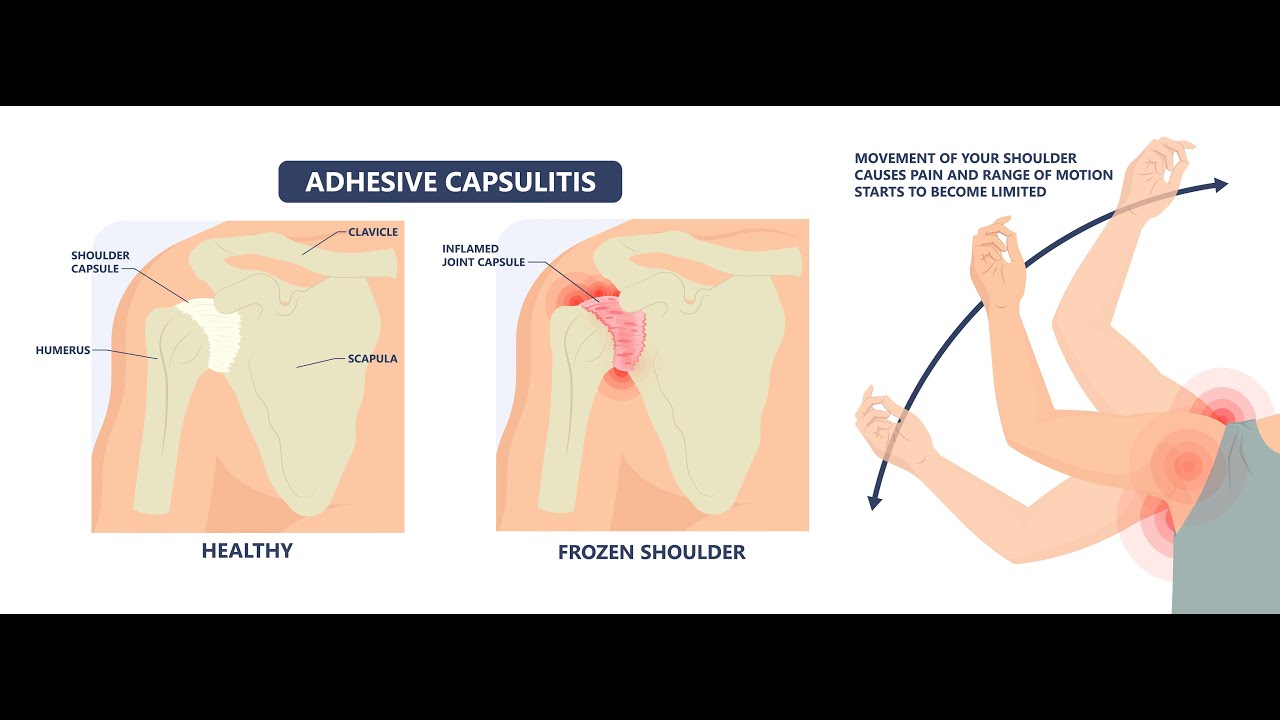Как лечить капсулит. Капсулит плечевого сустава.