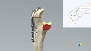 Olecranon – Transverse Fracture 21B1 - Tension Band Plate Fixation Using One-third Tubular Plate