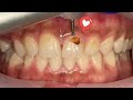 Proses Penambalan Gigi Depan | Dentist | Dokter Gigi Tri Putra