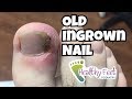 Old Ingrown Nail. Ingrown Nail Removal.