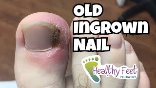 Old Ingrown Nail. Ingrown Nail Removal.