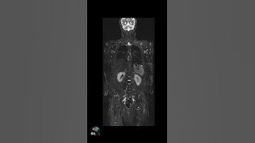 MRI – Whole Body Imaging w/Deep Resolve