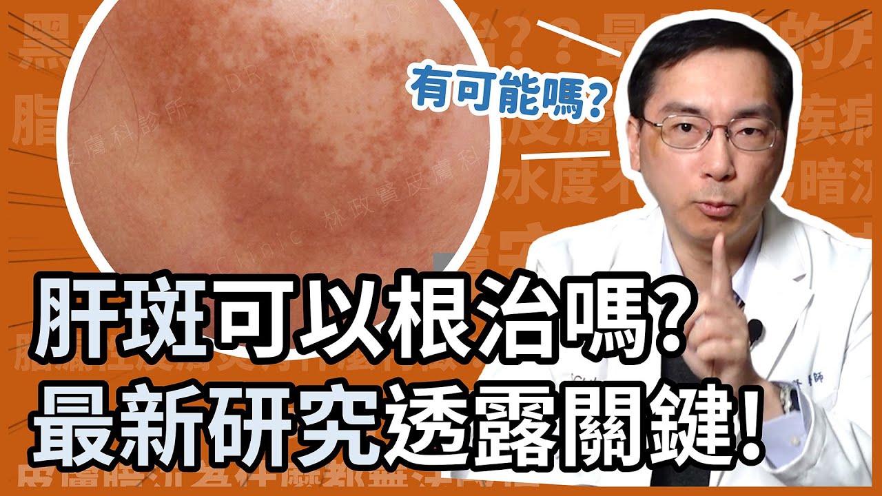 肝斑可以根治嗎？最新研究透露治療關鍵！皮膚科林政賢醫師分析給你聽！