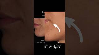 Filler BEFORE AND AFTER! #injectablefillers #filler #cosmeticdermatology #beforeandafter