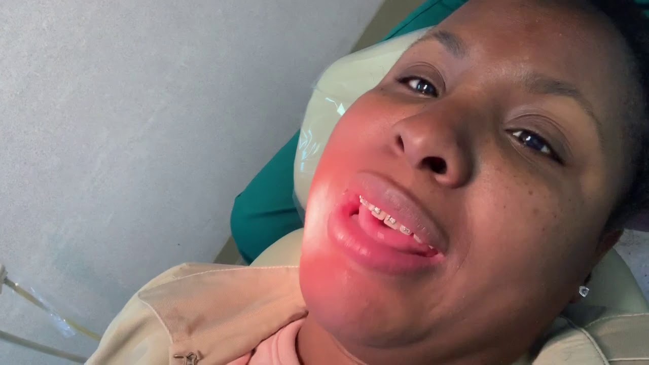 My Bracket Came Off & Then This Happened Adult Braces All Things Ru