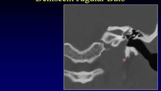 Temporal Bone Pathology 8: Tinnitus