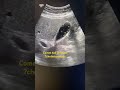 Comet tail artifact cholesterolosis gall bladder ultrasound