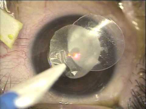 Amniotic membrane disc adjunct to post-CXL healing for keratoconus. kanellopoulos, MD