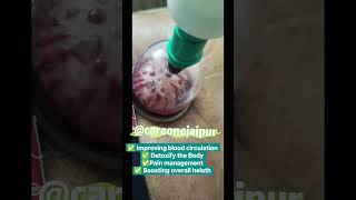 #naturopathy #wetcuppingtherapy #hijamacupping #shortvideo #bodydetox #ayurved #skincare #curedetox