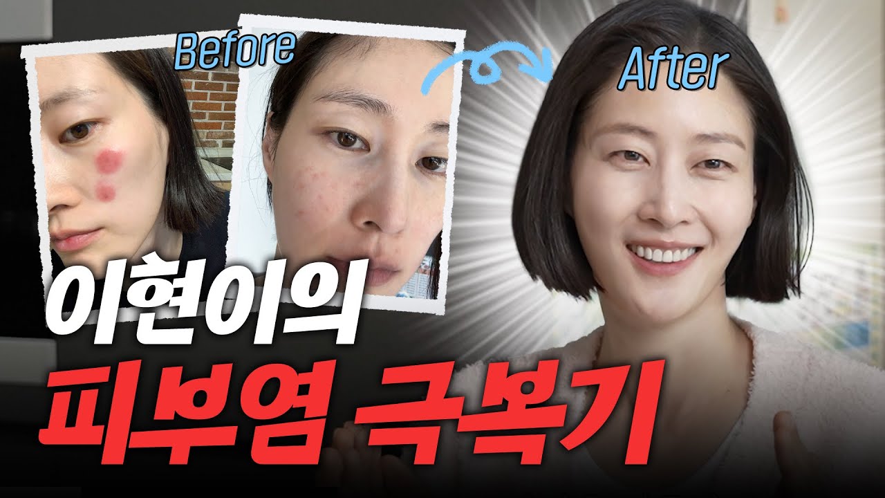 [최초공개]단 3개 끊고 피부 트러블 해결한 초간단 비법 (해독주스, 민감성피부, 이벤트)