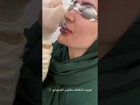 توريد الشفايف وعلاج التصبغات بالليزر التقشير الكربوني بالليزر في عيادات الشاكرين