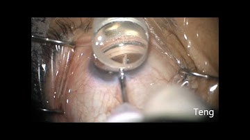 Trabectome Cataract Extraction in Exfoliation Glaucoma. Chris Teng, MD