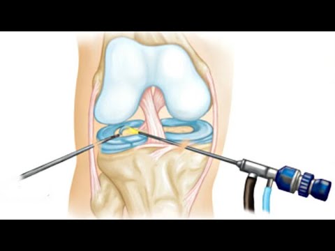 Video: Kolenski Meniskus - Zdravljenje Kolenskega Meniskusa Z Ljudskimi Zdravili In Metodami Doma