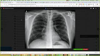 [CS489] Tutorial: Classification of Chest X Rays for COVID19 Detection screenshot 3