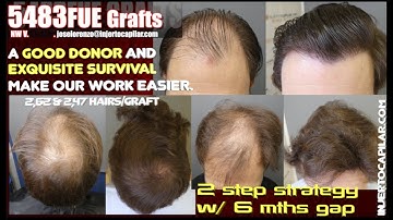 5483FUE Grafts. NW V. 2step strategy with 6month gap. 2,62 &2,47h/graft.Injertocapilar.com.2762/2022