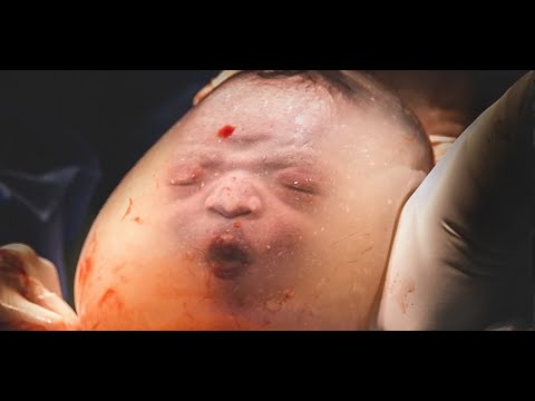 😲 Parto velado: imágenes increíbles de una cesárea en la que el bebé nace dentro del saco amniótico
