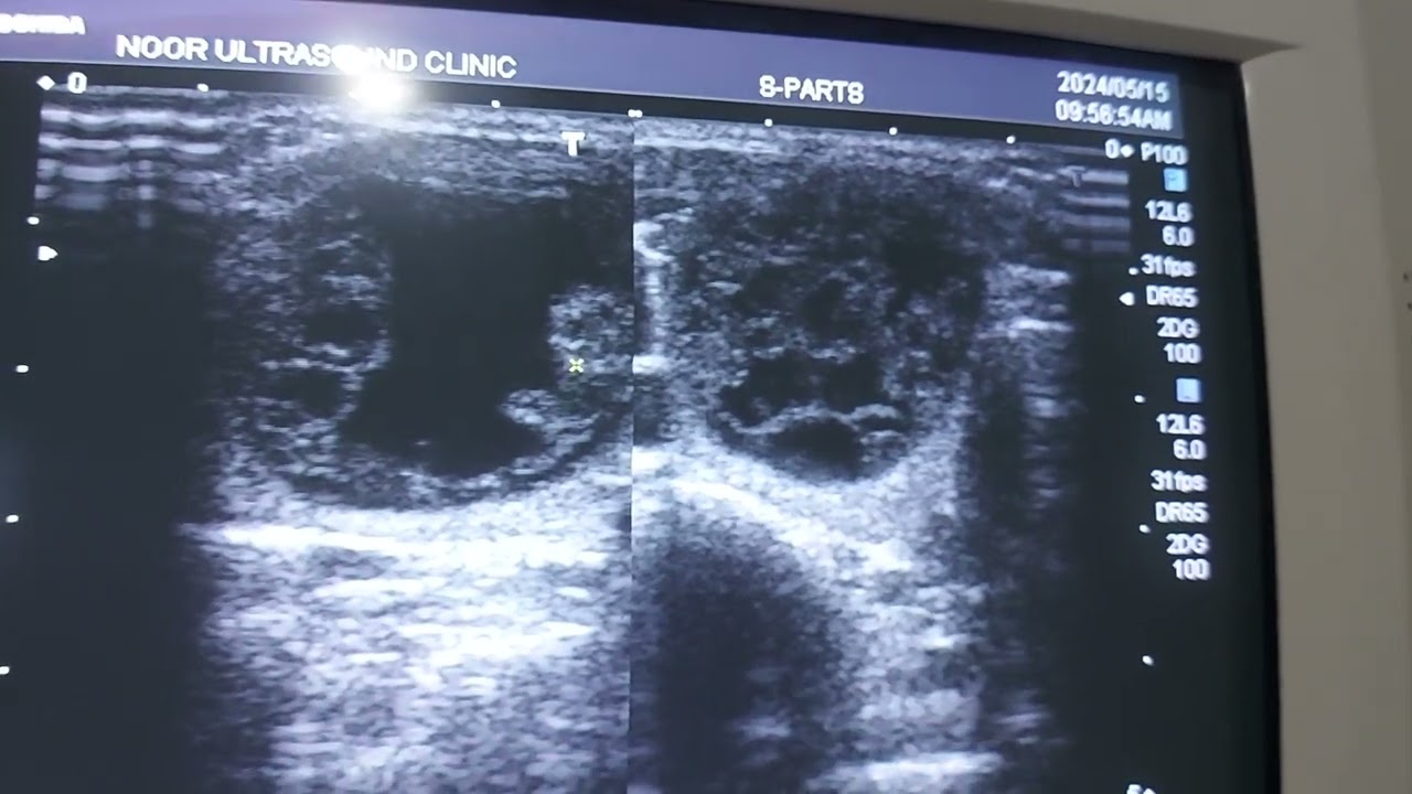Complex solitary module in thyroid gland.. Ultrasound neck.Ultrasound thyroid gland