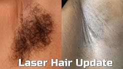 6th Laser Hair Removal Treatment on Brown Skin| Laser Away Update 