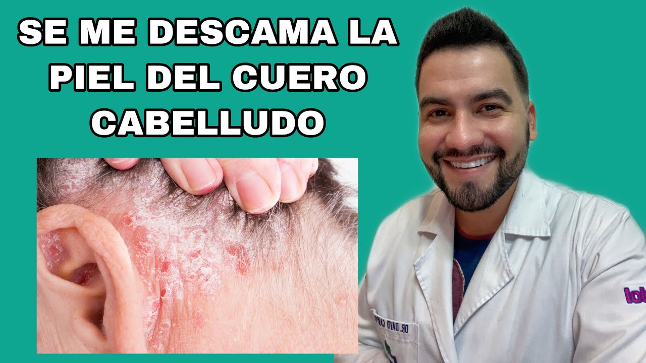 ME SALE COMO SEBO DE LA CABEZA / DERMATITIS SEBORREICA / CASPA EN LA