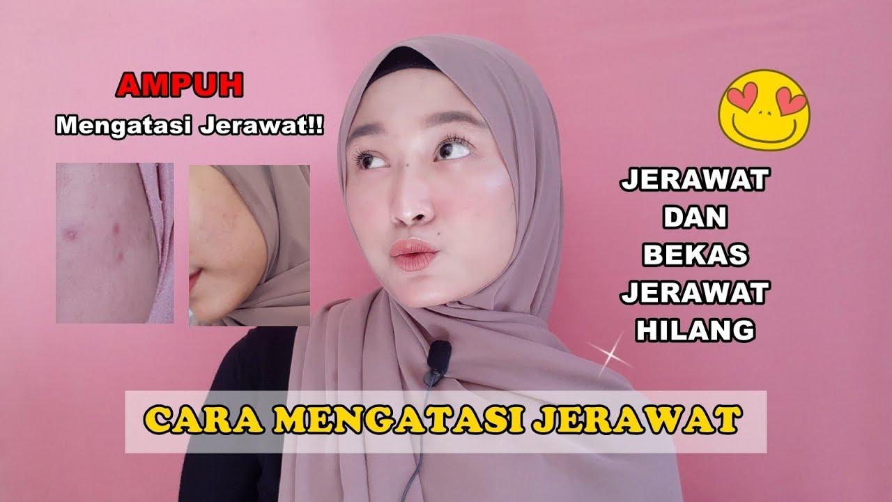 CARA MENGATASI JERAWAT | Hal-Hal Yang Tidak Boleh Dilakukan Ketika