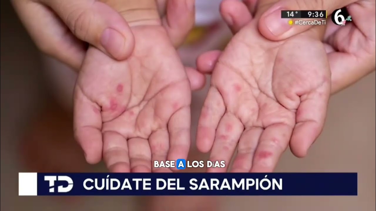 SARAMPION ¿CÓMO PREVENIRLO? 🦠👀