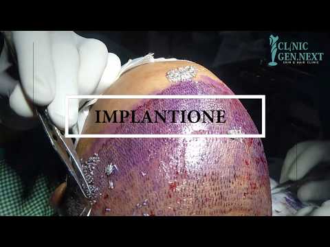 hair-implantation-treatment-procedure-done-by-clinicgennext(9717026461)