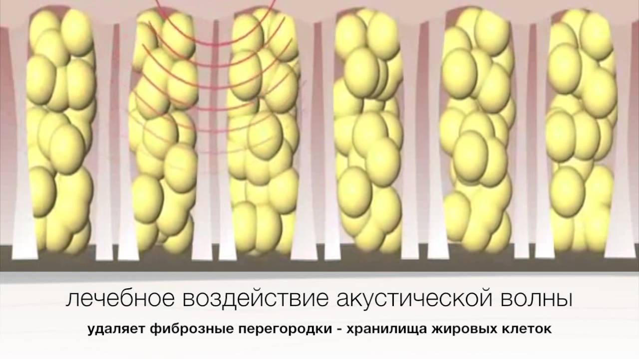 Лечение целлюлита ударно-волновой терапией. Аватаж - YouTube