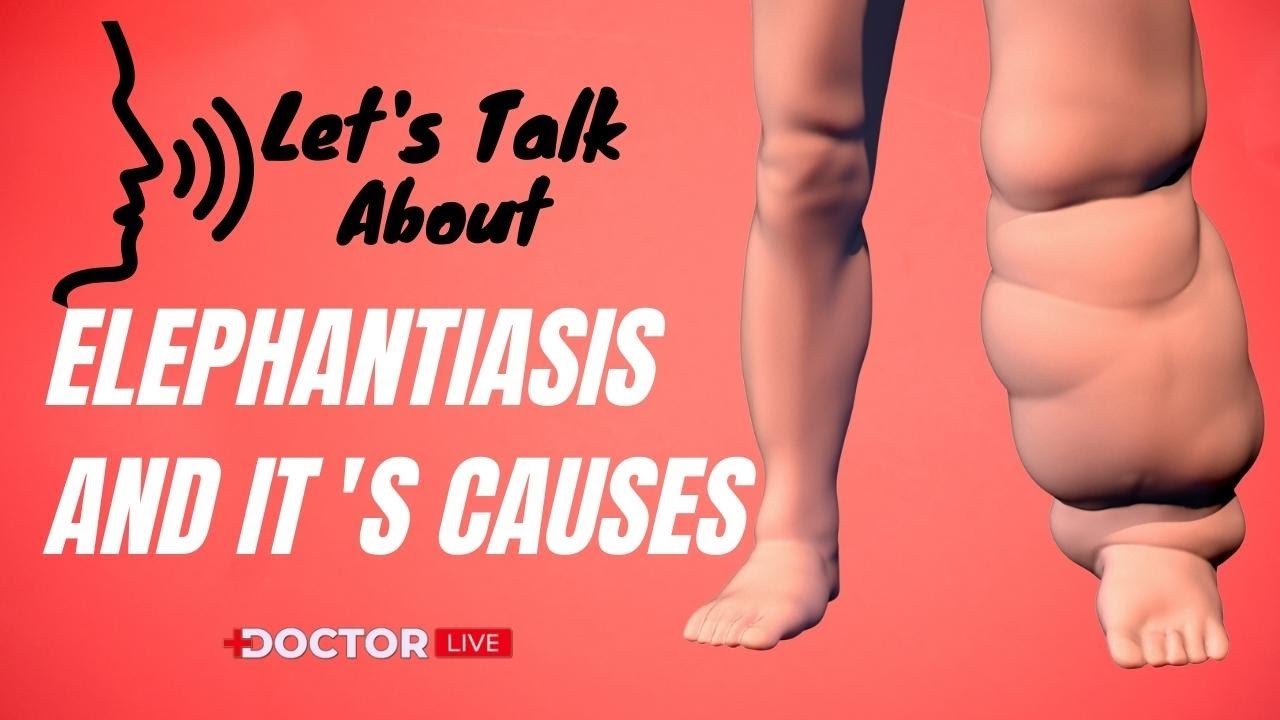 What is Elephantiasis and it's Causes | Doctor Live Medical Talks
